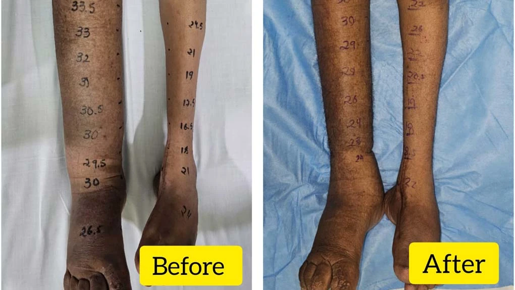 Do we really have an answer for lymphedema management ?