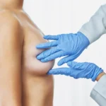 Breast Reconstruction After Cancer