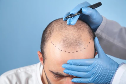 Advanced Hair Transplant Surgery
