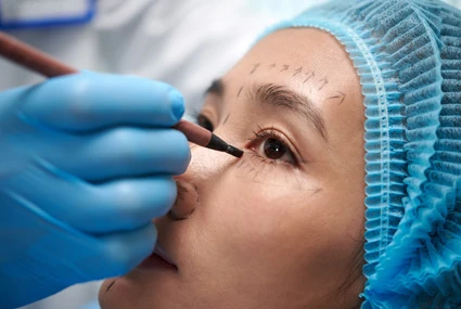 Blepharoplasty