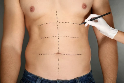 Gynecomastia