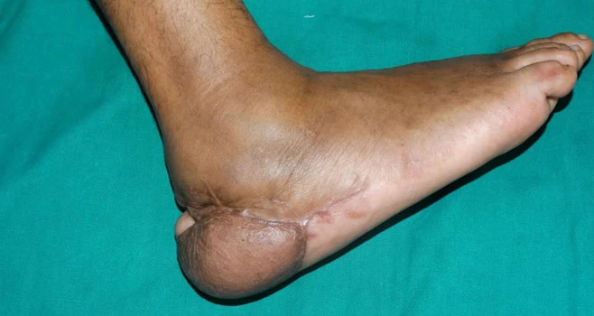 Heel Reconstruction Surgery