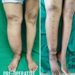 Lymphedema