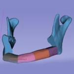 Mandibular Reconstruction using CAD CAM
