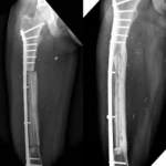 Ortho Reconstruction