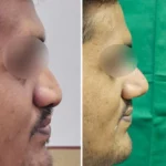 Rhinoplasty