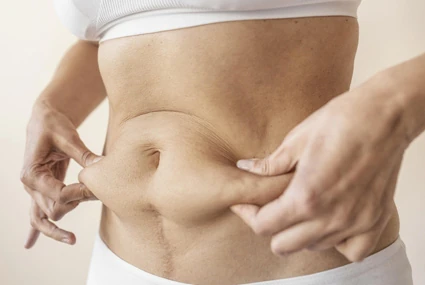 Tummy Tuck