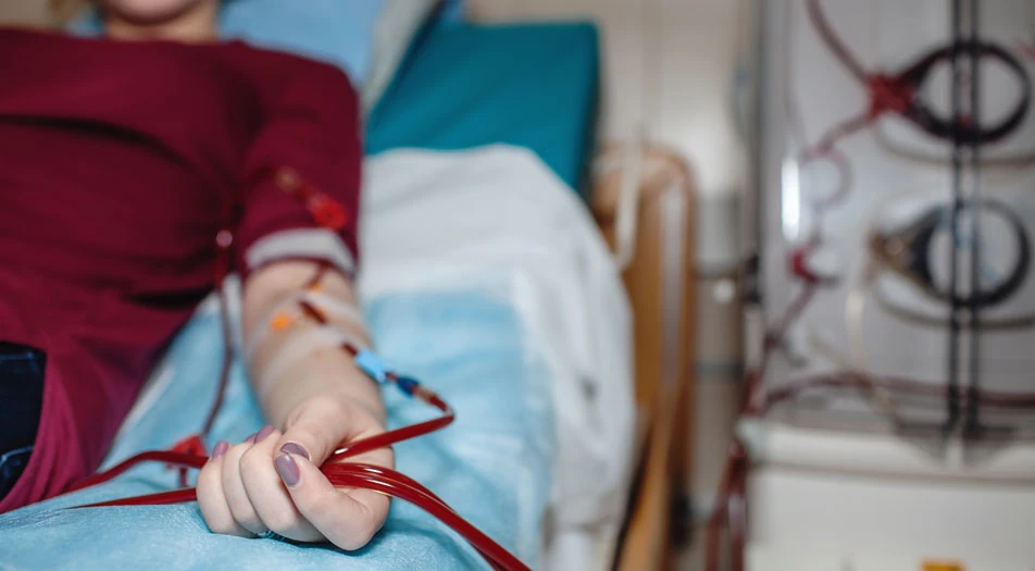 What is AV Fistula for Dialysis?