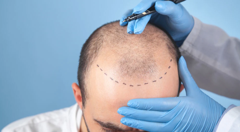 What is Advanced Hair Transplant Surgery?