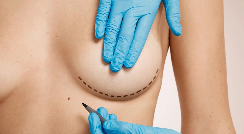 What is Breast Augmentation Surgery?