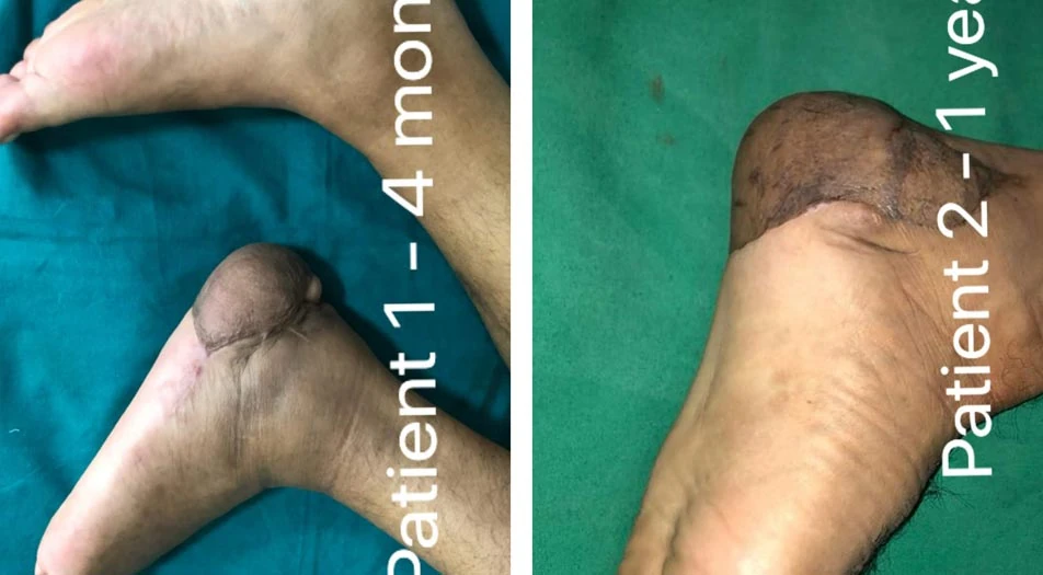 What is Diabetic Foot Surgery with Flaps and Skin Grafting?