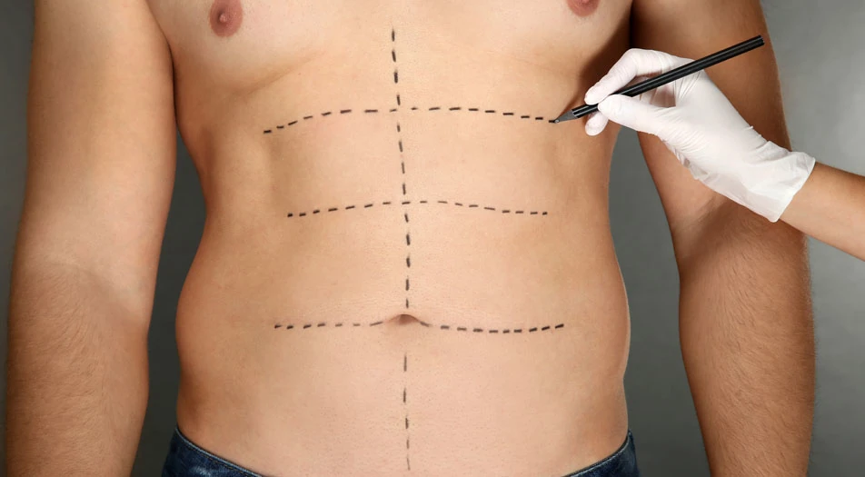 What is Gynecomastia Surgery?