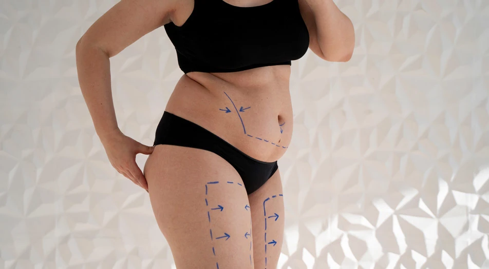what-is-liposuction