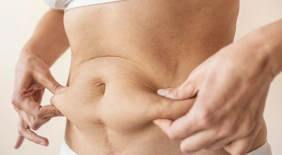 What is Tummy Tuck?